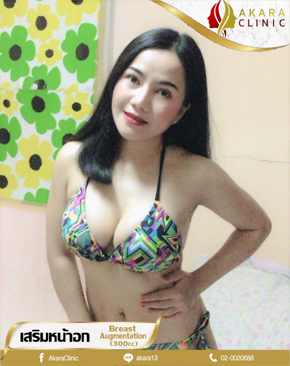 เสริมหน้าอก (Breast Surgery)